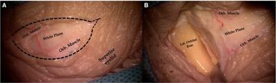 Superior eyelid endoscopic transorbital approach to the tentorial area: A qualitative and quantitative anatomic study